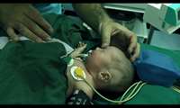 جراحی یک نوزاد 10 روزه مبتلا به ناهنجاری مادرزادی خط وسط در بیمارستان حضرت علی اصغر(ع)