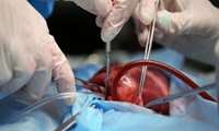 اهدای اعضای بیمار پس از آمبولی ریه و ایست کامل قلبی در دانشگاه علوم پزشکی ایران